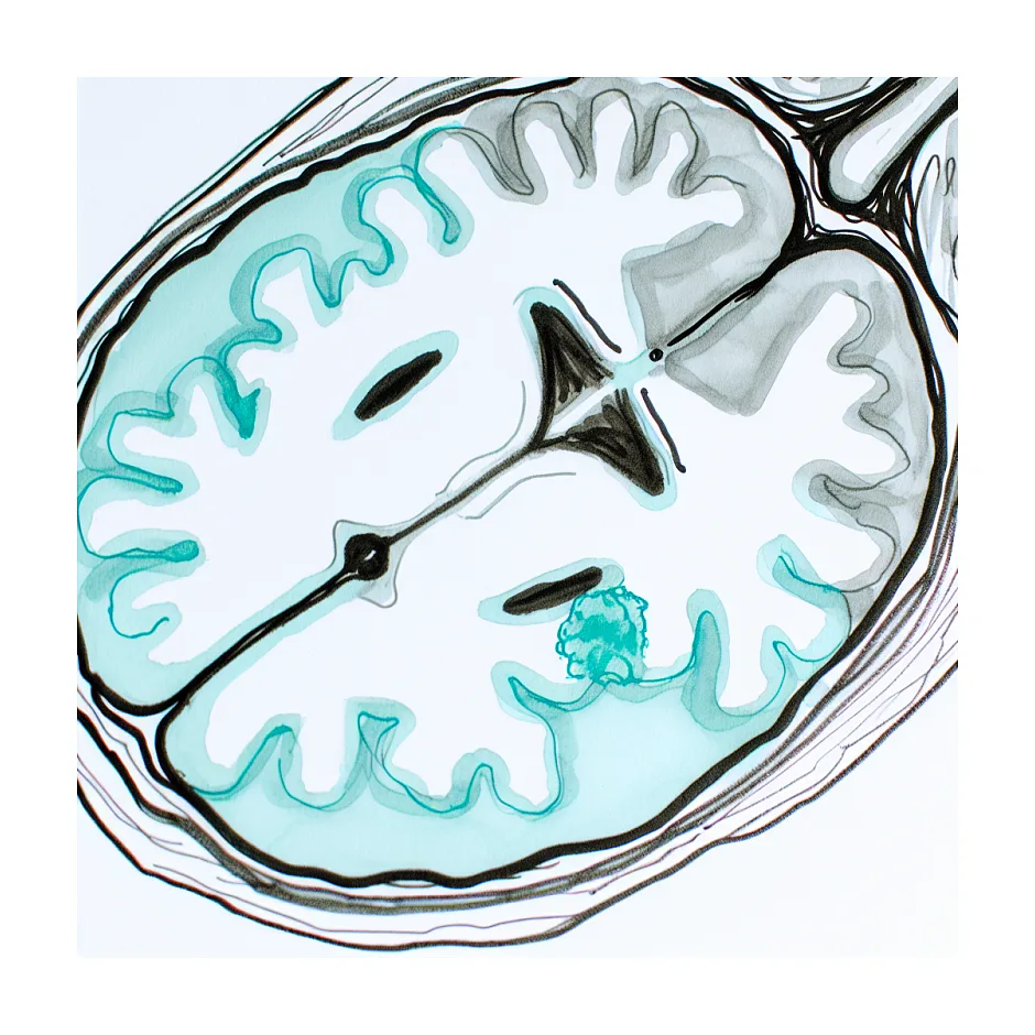 کانون سیگنال بالا در T2/FLAIR فرونتال یعنی چه؟