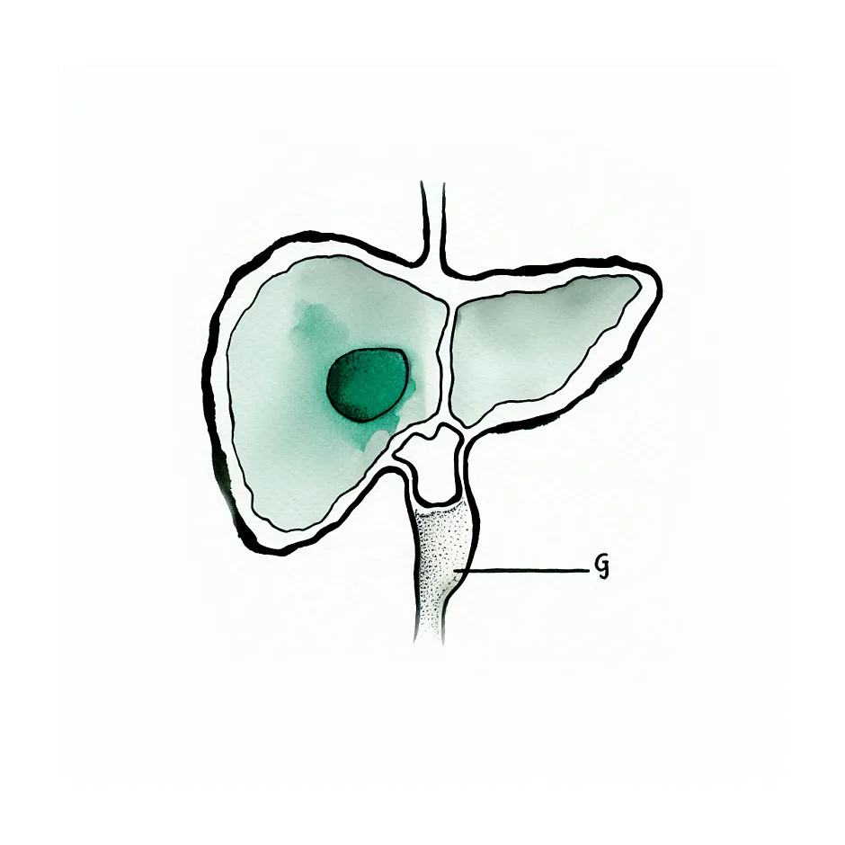 نیاز به جراحی برای سنگ کیسه صفرا ۵ میلیمتری