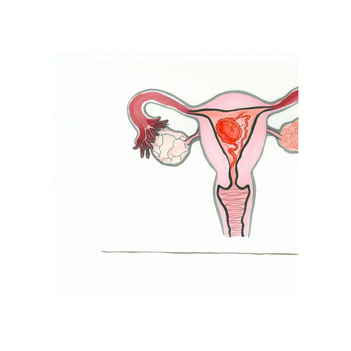 نحوه مصرف وروژست و نامنظمی پریود در اندومتریوز