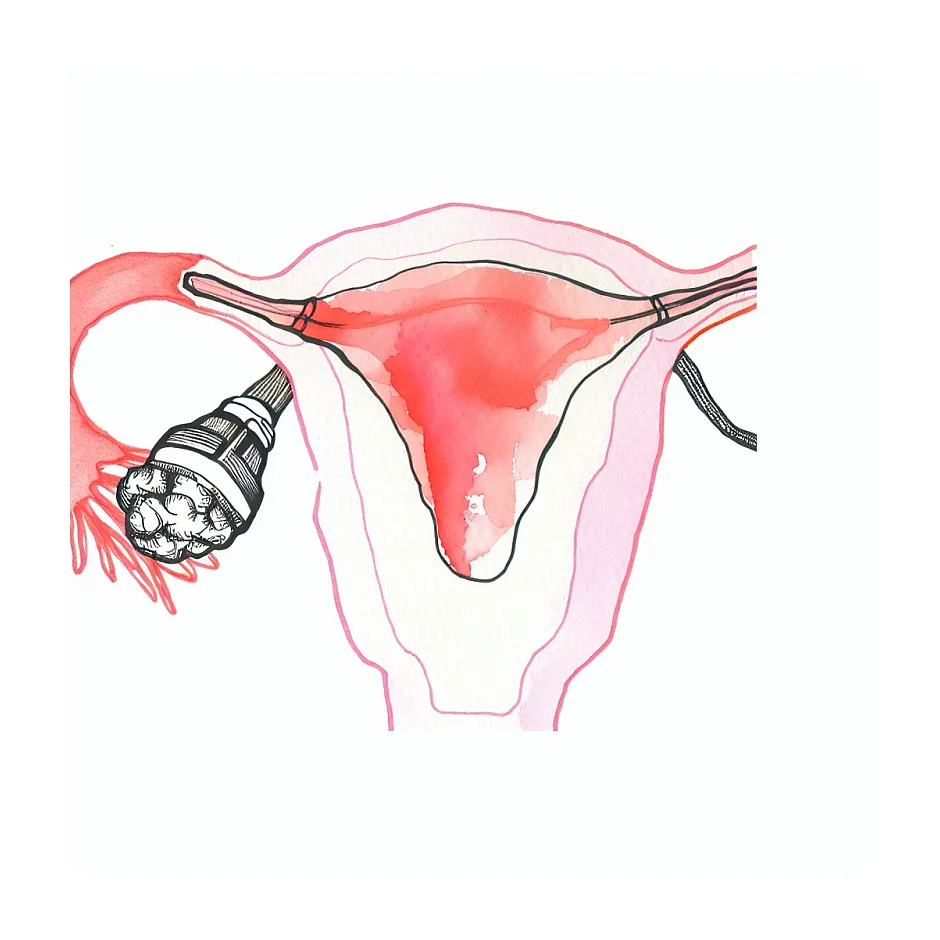 درمان میوم ساب‌سروزال پدانکوله و نگرانی از بزرگ شدن