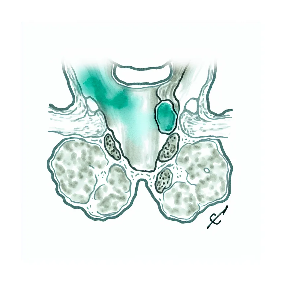 تورم طولانی غدد لنفاوی گردن؛ کی نگران شویم؟