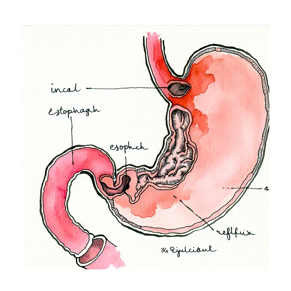 نحوه مصرف شربت امپرازول در نوزاد دچار رفلاکس