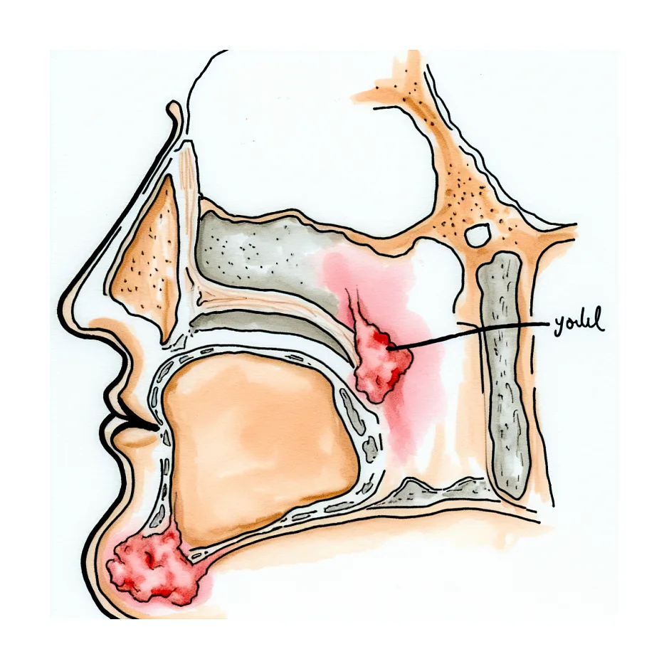 علت تورم صورت و گره لنفاوی زیر فک چپ