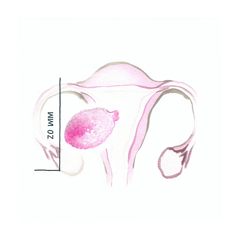 احتمال بارداری با فولیکول ۲۰ میلی‌متری