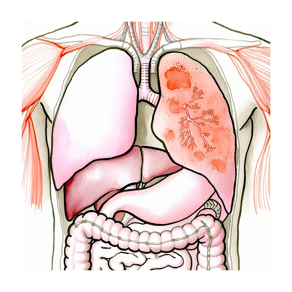 علت تب شبانه بدون علامت دیگر چیست؟