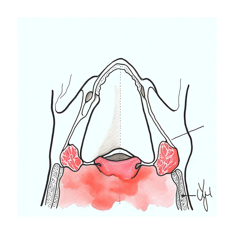 رشد مجدد لوزه بعد از جراحی امکان‌پذیر است؟