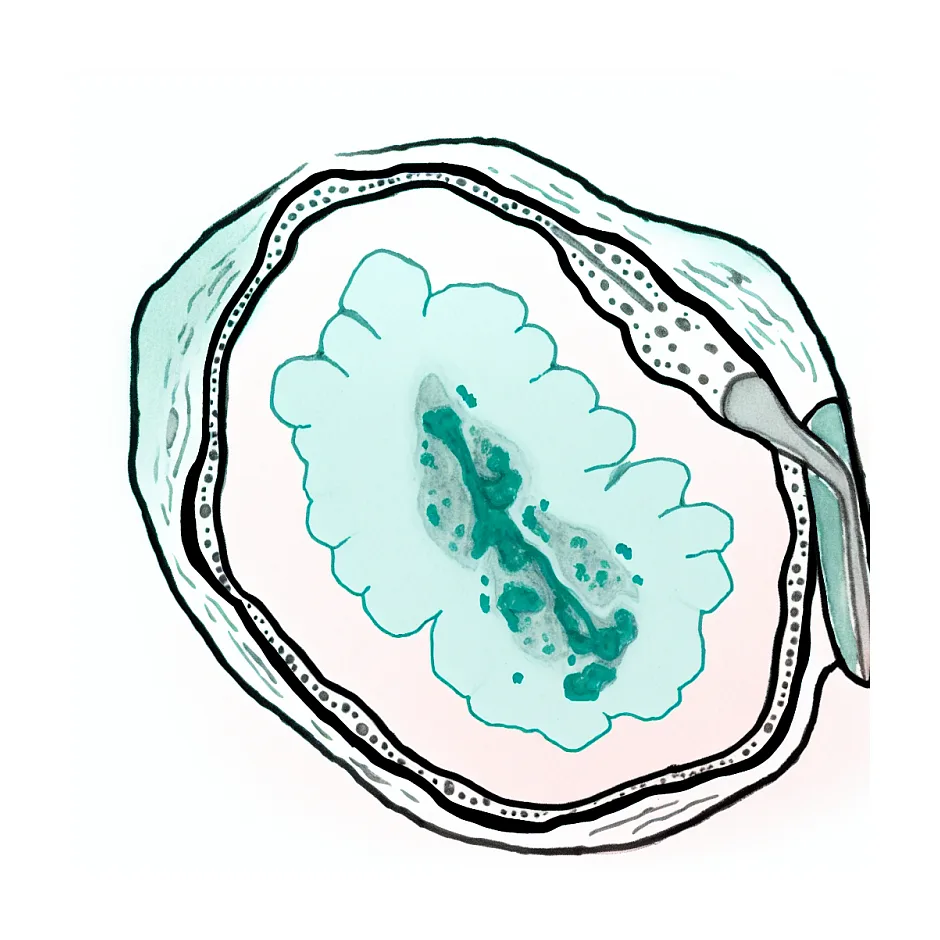 شیفت فلور واژینال و واژینوز باکتریال در پاپ اسمیر