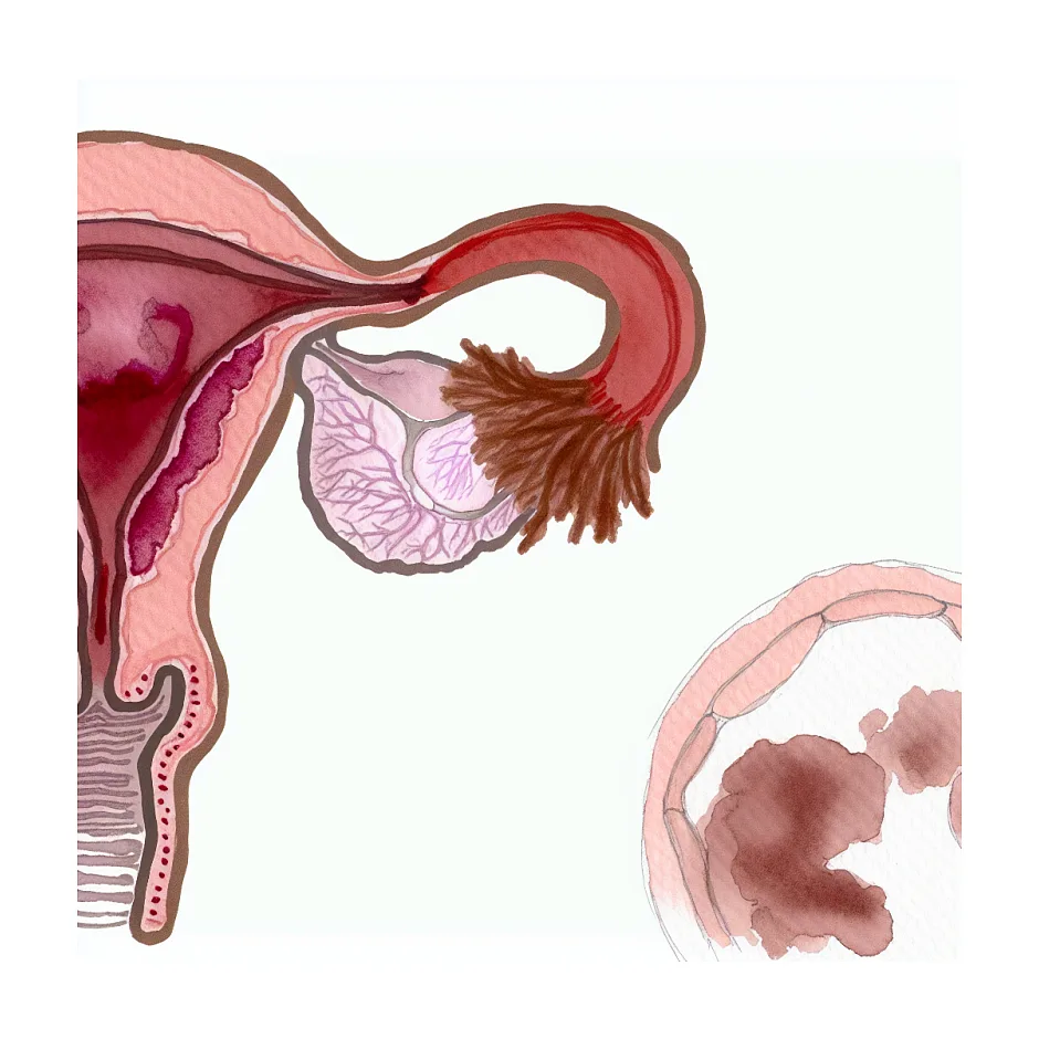 آیا خون پاره شدن پرده بکارت می‌تواند قهوه‌ای باشد؟