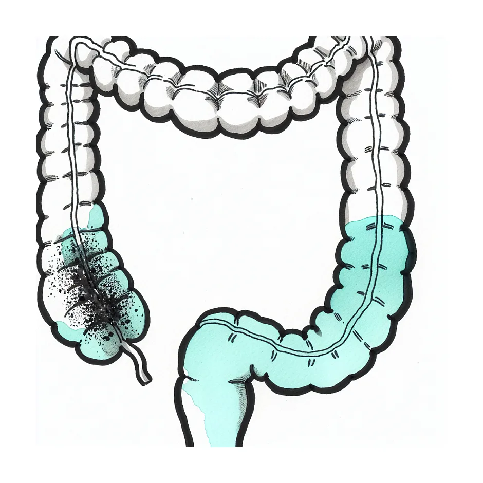 علت دانه‌های ریز و سیاه در مدفوع کودک دو ساله
