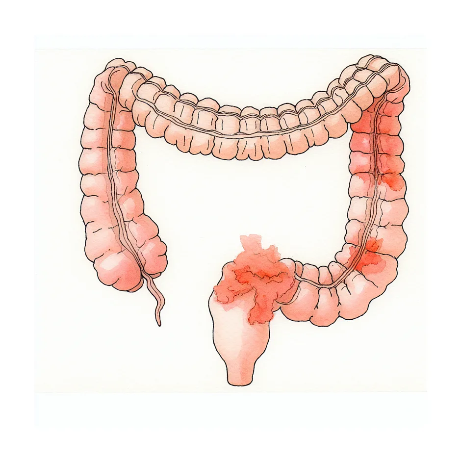 لاکتولوز برای یبوست و شقاق؛ آیا مصرف طولانی امن است؟