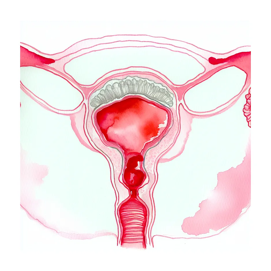 لکه‌بینی بعد از هیسترکتومی و برداشتن تخمدان