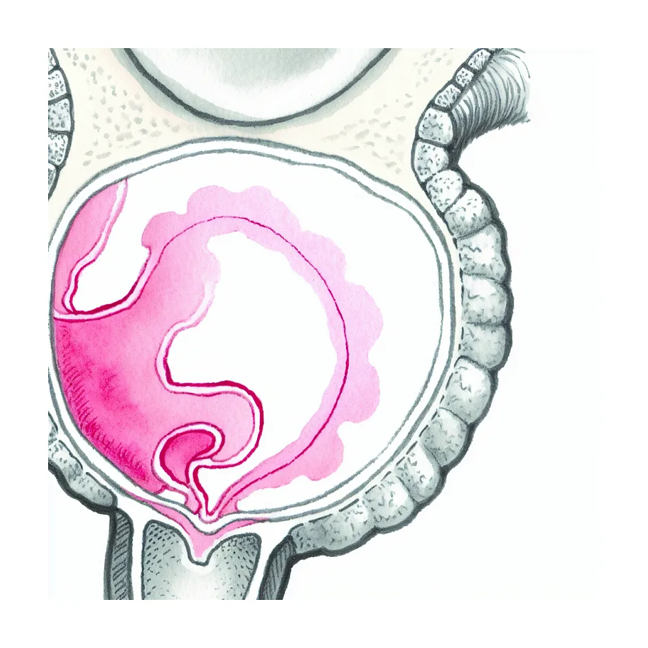 تفاوت سونوگرافی واژینال و پاپ اسمیر برای سرطان دهانه رحم