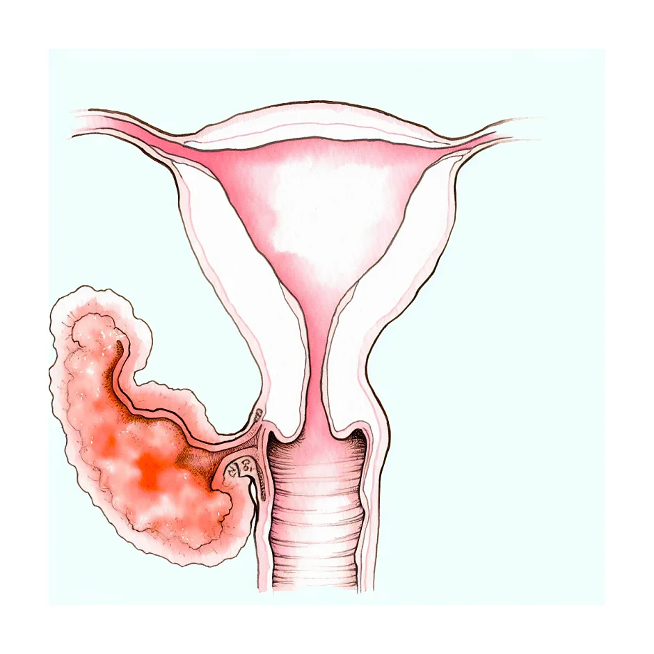 بقایای بارداری ۵ میلیمتری؛ آیا نیاز به کورتاژ است؟