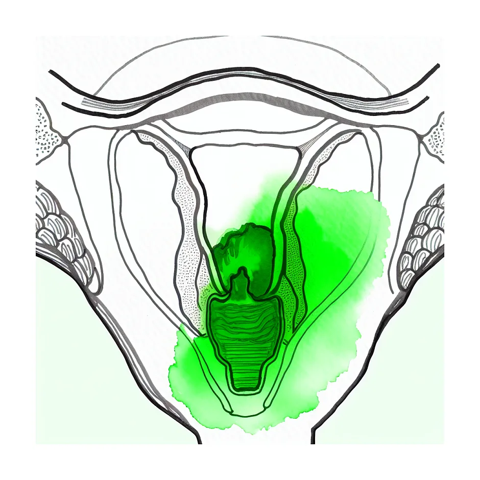 عوارض پماد لکورکس و علت ترشحات سبز