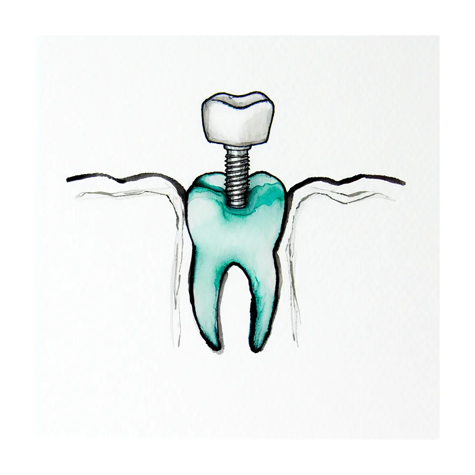 فاصله زمانی مناسب بین پست دندان و روکش