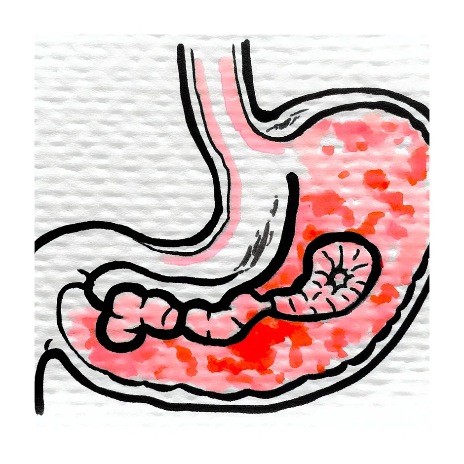 علت درد معده شبیه گرسنگی مداوم چیست؟