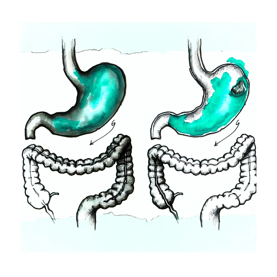 روزه بعد از برداشتن سر پانکراس و پولیپ معده