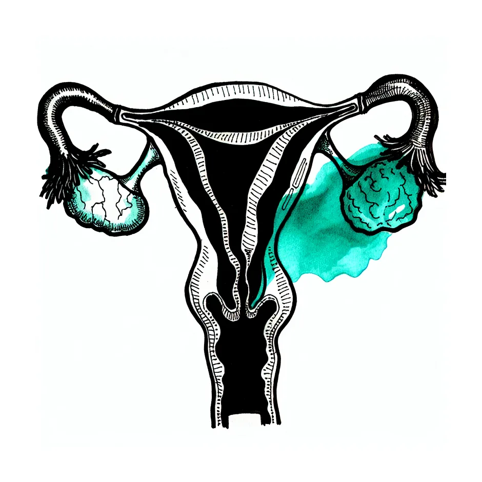 تجمع مایع در حفره اندومتری و اهمیت ارزیابی های مکمل در سونوگرافی