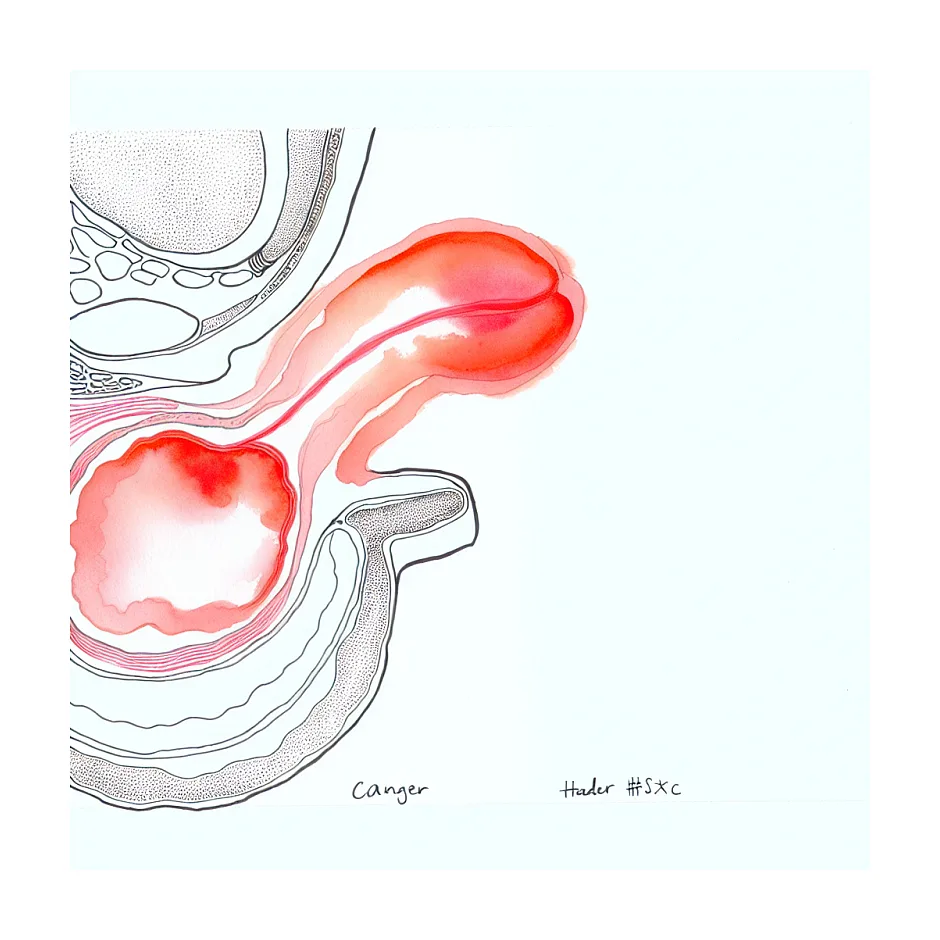 آیا متفورمین باعث اختلال نعوظ در مردان می‌شود؟