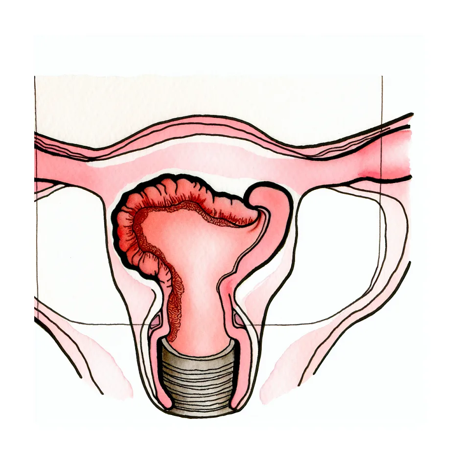 نشانه‌های باز شدن بخیه سرکلاژ در بارداری