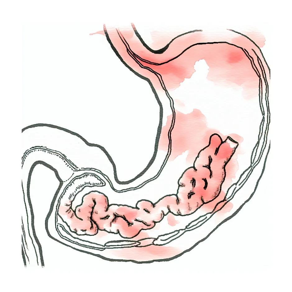 رودل شدن و احساس گیر کردن غذا در سر دل