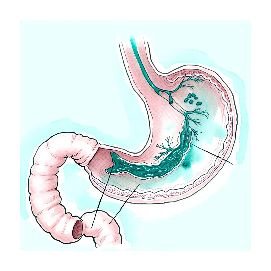 علت تهوع و گیر در گلو بعد از نوشیدن مایعات