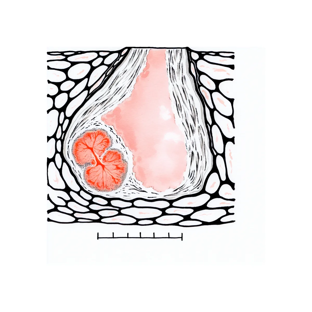 فیبروگلاندولار و کیست سینه در سونوگرافی یعنی چه؟