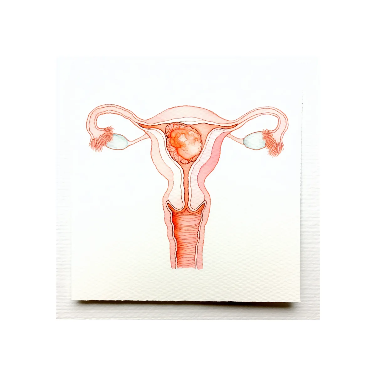 یولک‌ساک بدون فتال پل در سونوگرافی یعنی چه؟