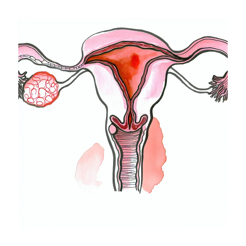 افزایش دوز هیدروکسی پروژسترون در بارداری، ضرر دارد؟