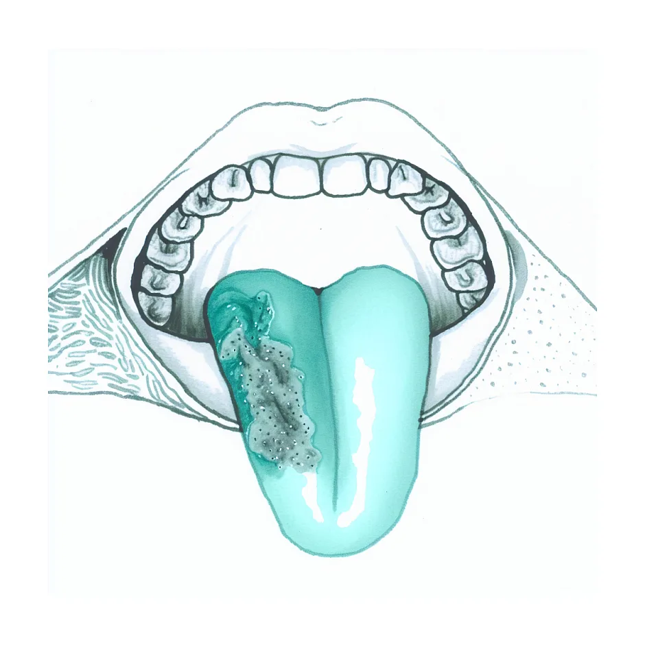 تفاوت پرز زبان و زگیل دهان و علت برجسته شدن آن