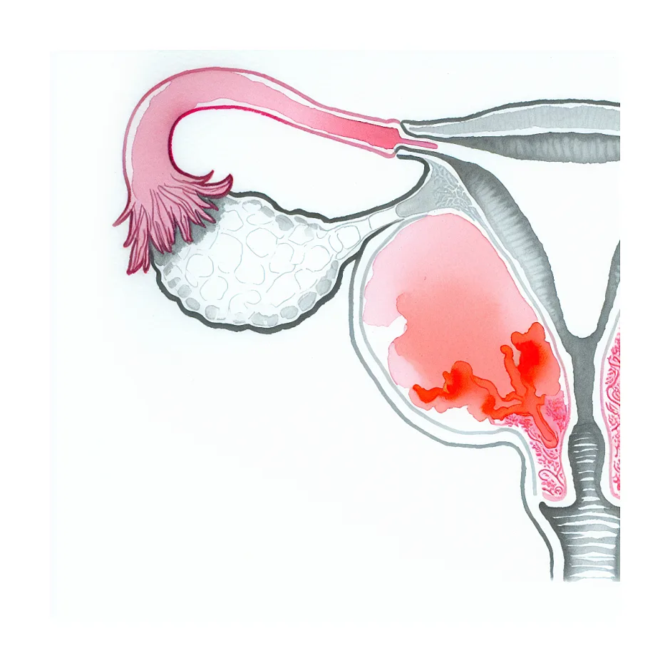 علت دیسمنوره: درد سمت راست شکم در زمان پریود