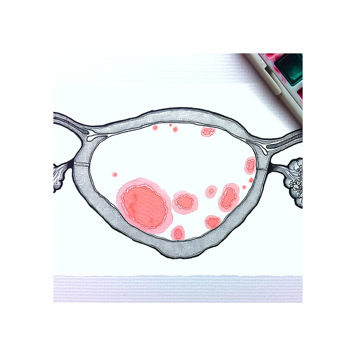 خطرات مصرف طولانی سیپروترون کامپاند در PCO