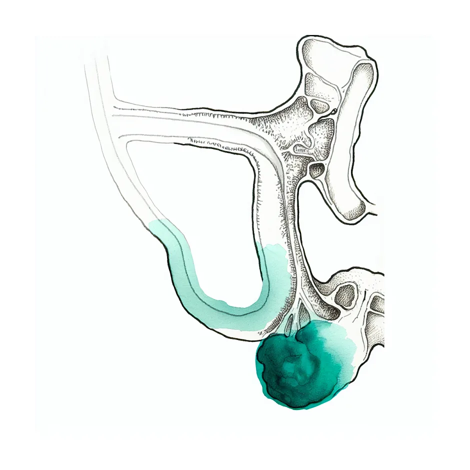 درمان سنگ دیستال حالب ۵ میلی‌متری و امکان دفع خودبه‌خودی