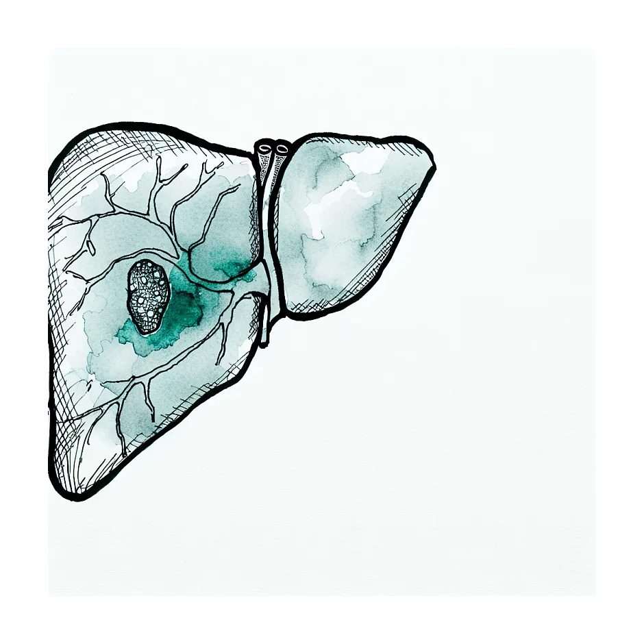 گرانولوم کلسیفیه کبد: آیا خطرناک هست؟ | آیا باید نگران باشیم؟