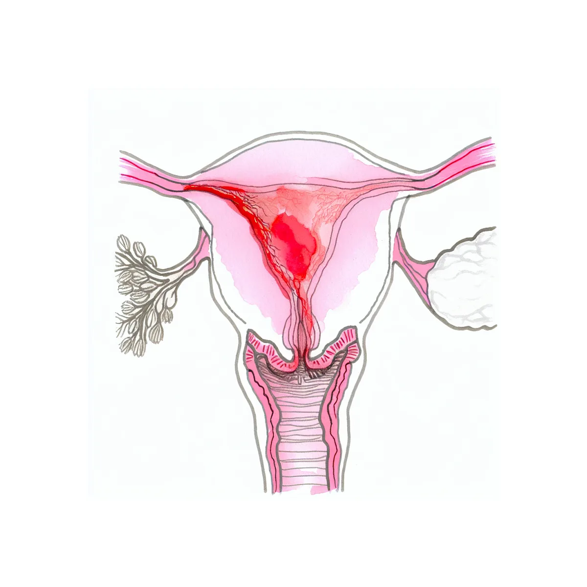 مصرف همزمان مترونیدازول و سیپروفلوکساسین برای عفونت واژن