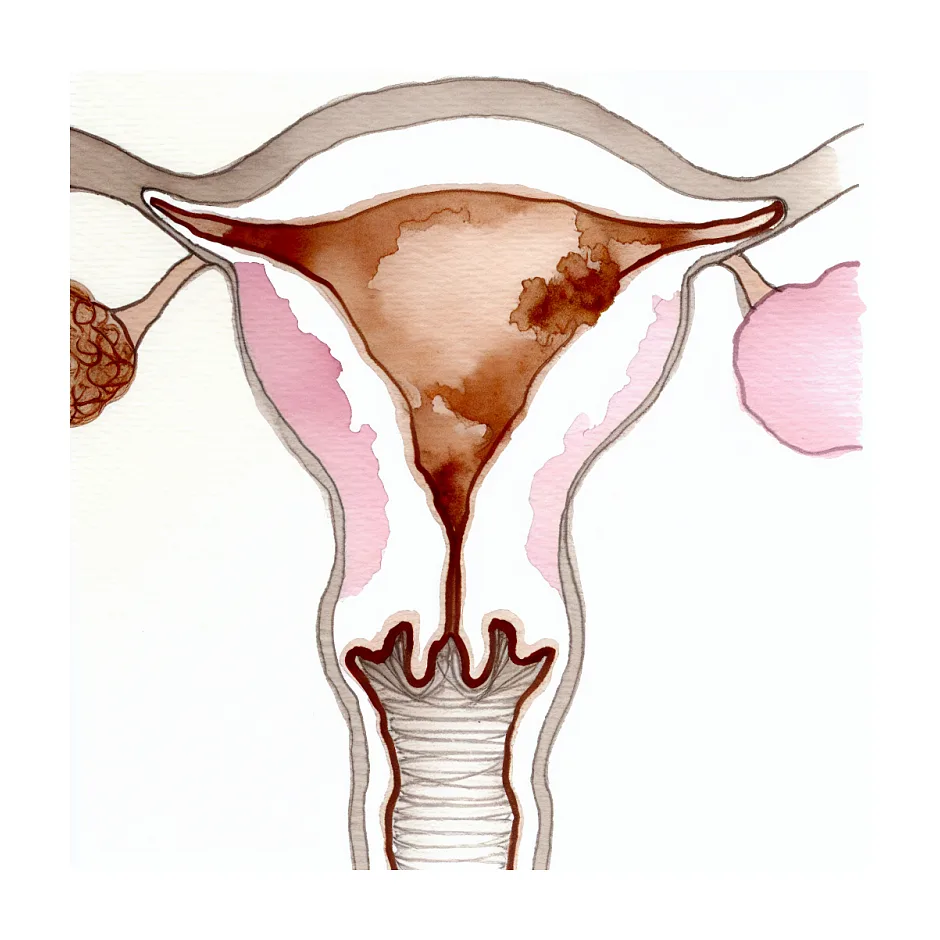ترشحات قهوه‌ای به‌جای پریود و قطع قاعدگی