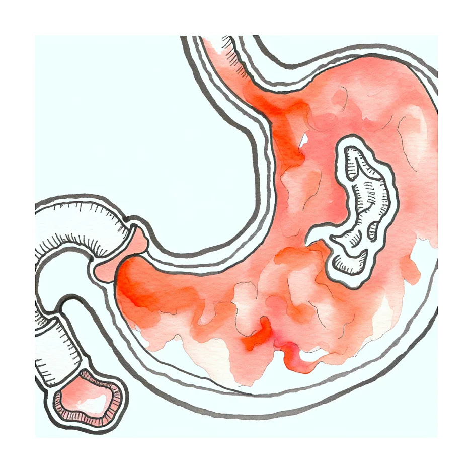 مصرف فاموتیدین در بارداری، آیا برای جنین امن است؟