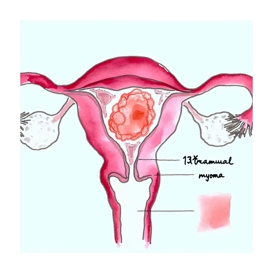 میوم اینترامورال ۱۳×۲۲ میلی در بارداری چقدر خطرناک است؟