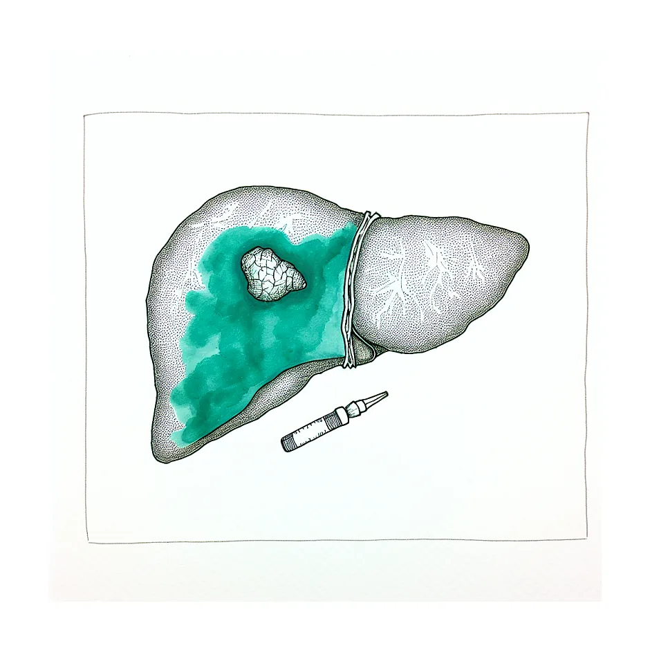 مراقبت‌های بعد از عمل کیست هیداتیک و مدت نقاهت