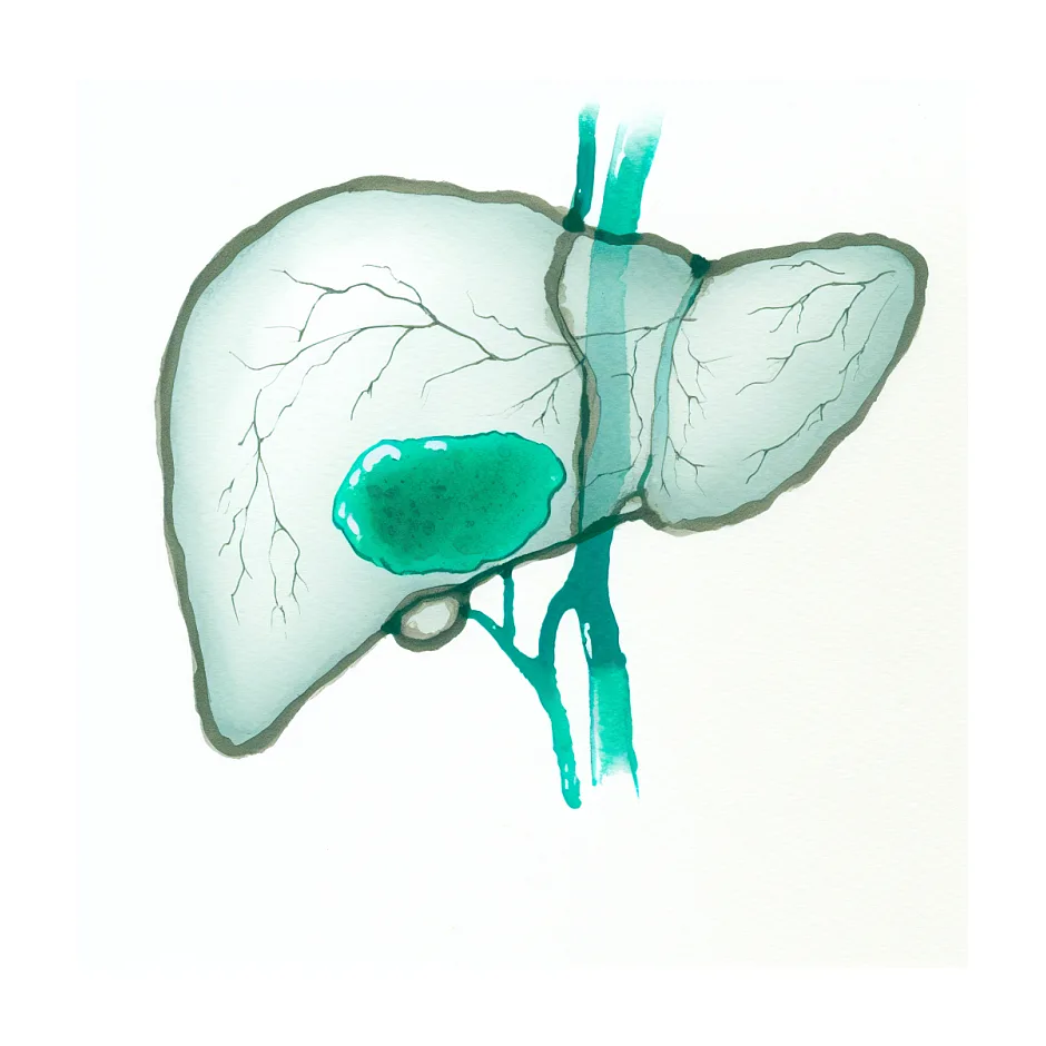 ارتباط سنگ کیسه صفرا و خارش پوست بدن