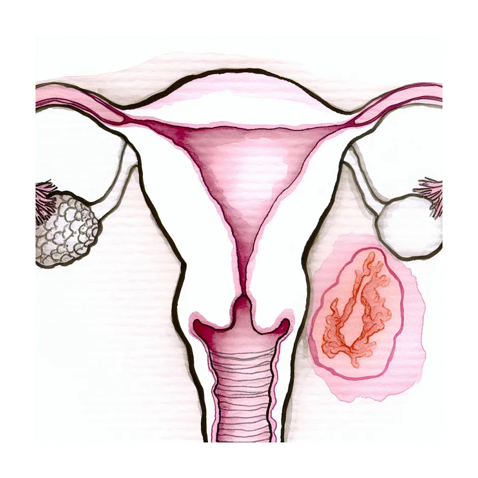 علت لکه بینی بدون پریود: خونریزی غیرعادی بدون دلیل واضح