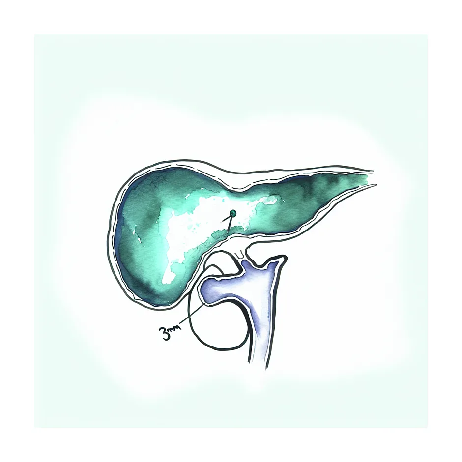 درمان کانون اکوژن ۳ میلی‌متری کیسه صفرا