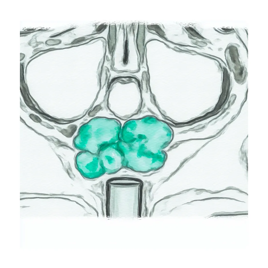 تشخیص غدد لنفاوی در MRI گردن: آیا امکان‌پذیر است؟
