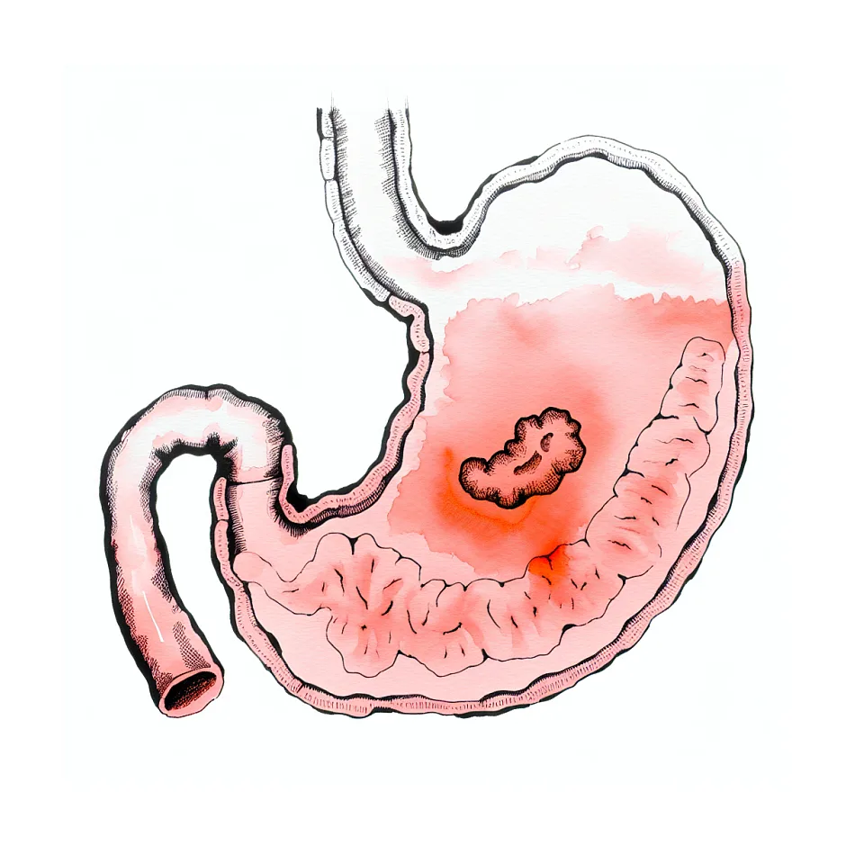 عدم پاسخ به شیمی‌درمانی سرطان معده چه کار کنم؟
