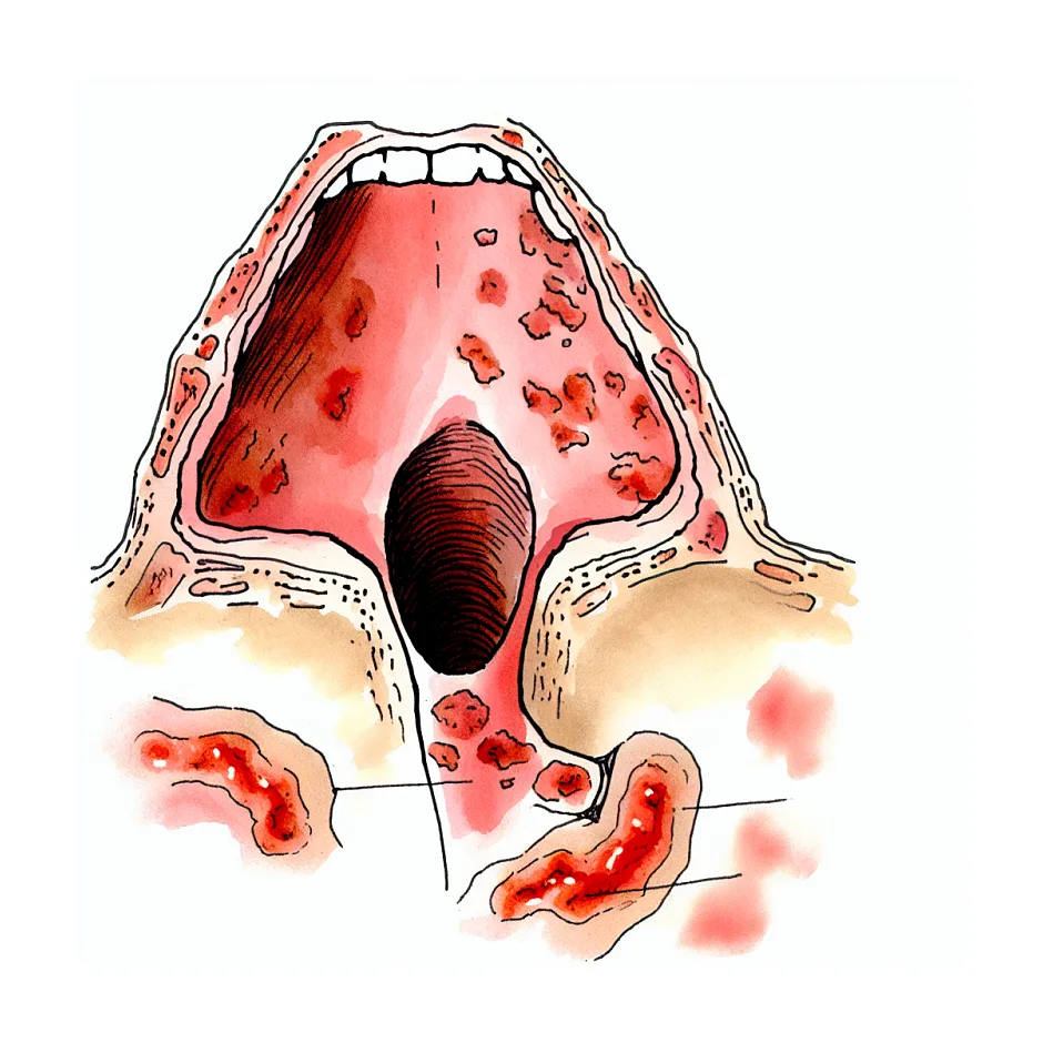 دانه و تاول انتهای گلو؛ آیا نشانه سرطان است؟