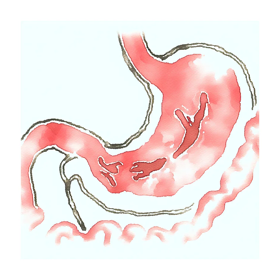 نکسیوم یا امپرازول در ریفلاکس نوزادان؟