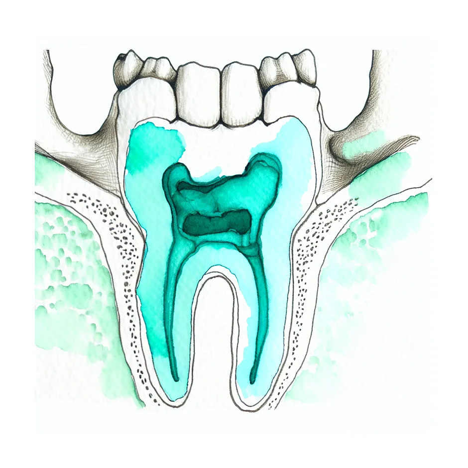 بیرون زدن استخوان فک بعد از کشیدن دندان عقل