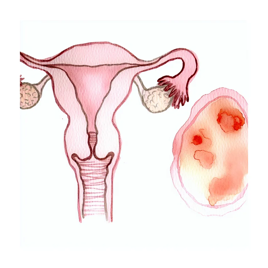 ماندگاری اثر آمپول اچ‌سی‌جی و بارداری شیمیایی