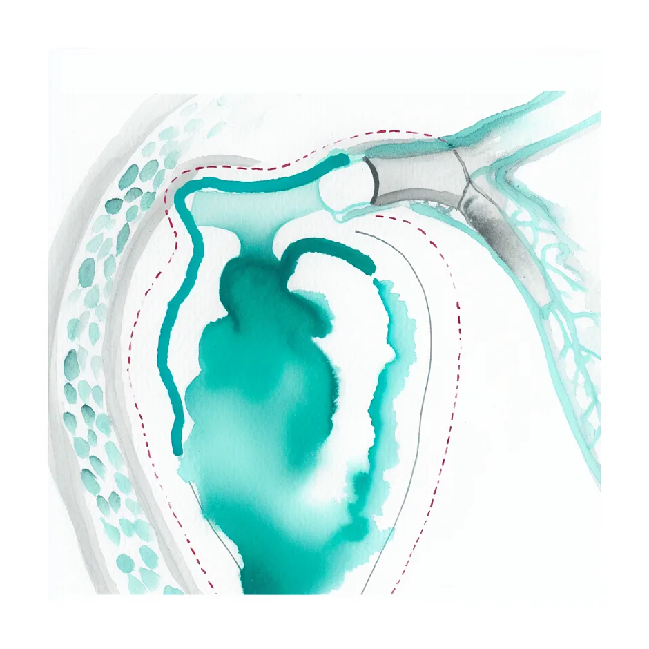 افزایش شاخص PI شریان رحمی در بارداری و مصرف آسپیرین