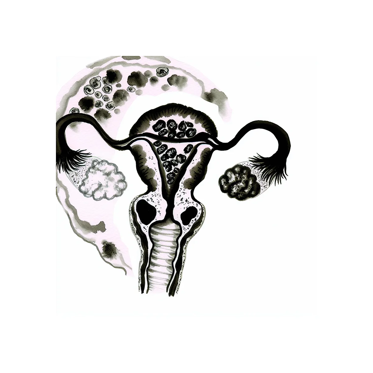 شانس بارداری طبیعی با ذخیره تخمدان کم و کیست